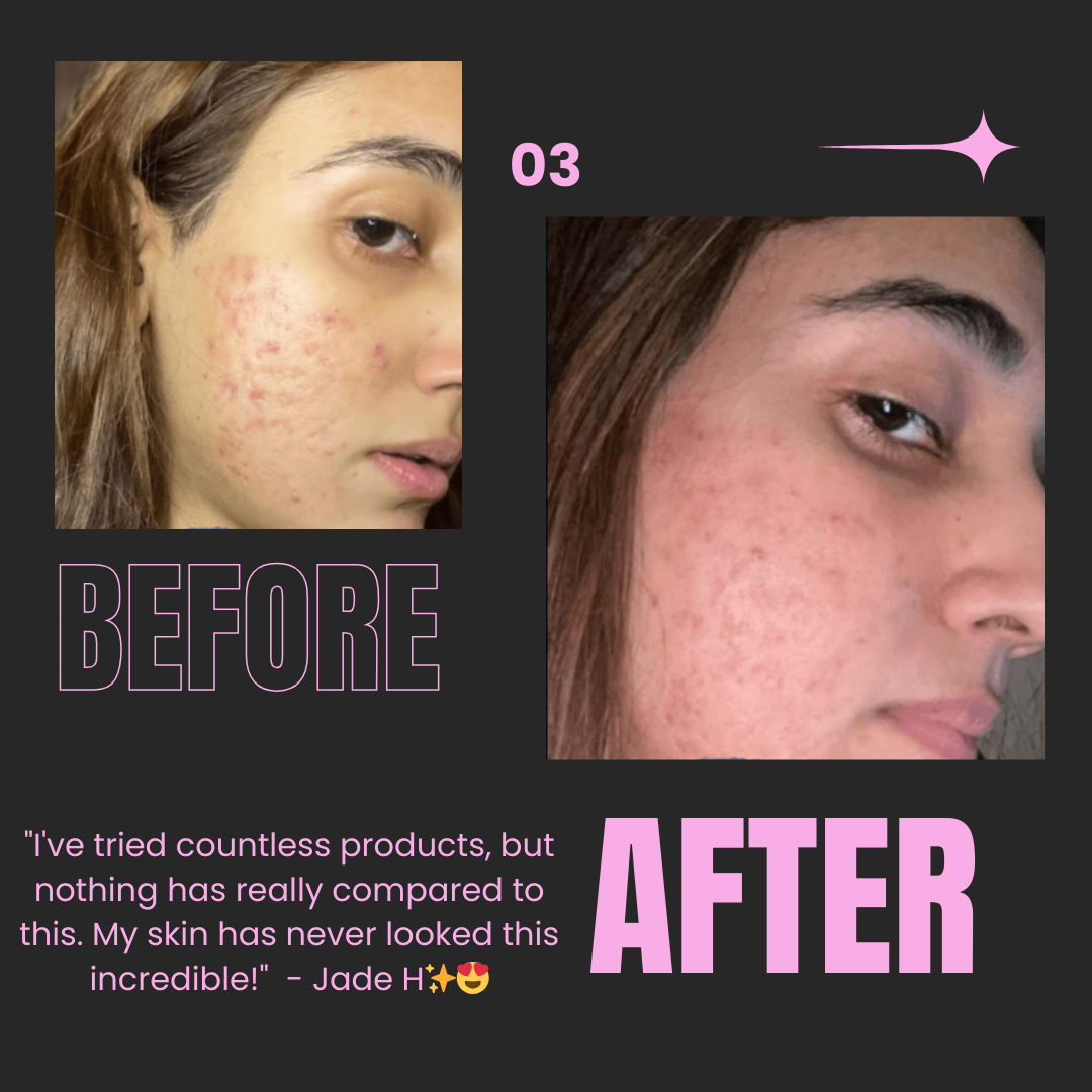 Voor en na foto's van vrouw met acne, zichtbaar verbeterde huid na behandeling.
