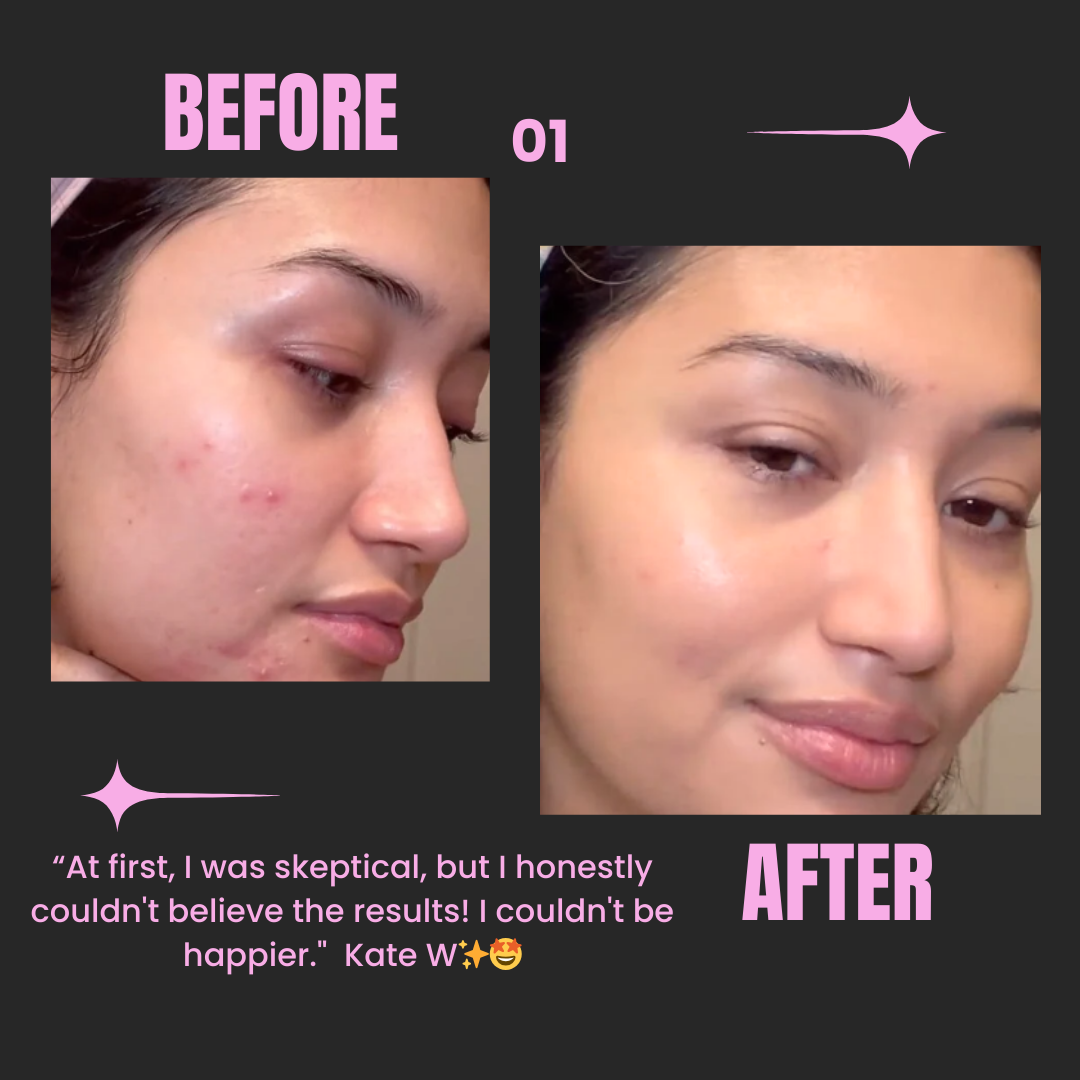 Voor en na foto's van vrouw met acne, zichtbare verbetering na gebruik van huidproduct.