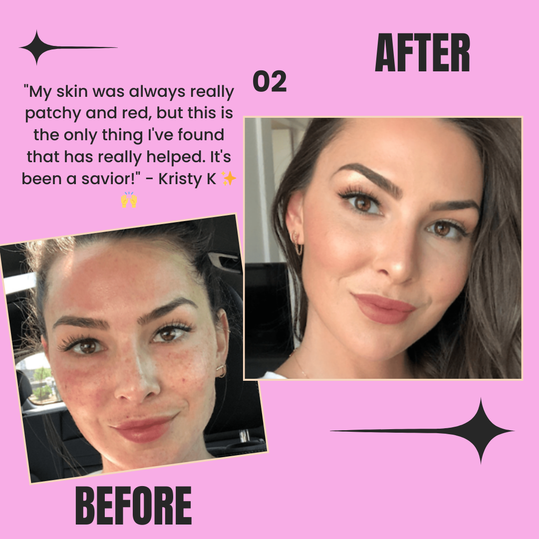 Voor en na foto's van vrouw met rode huid, zichtbaar verbeterde huid na behandeling.